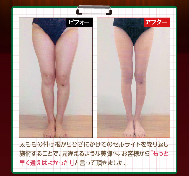 太ももの付け根からひざにかけてのセルライトを繰り返し施術することで、見違えるような美脚へ。お客様から「もっと早く通えばよかった！」と言って頂きました。