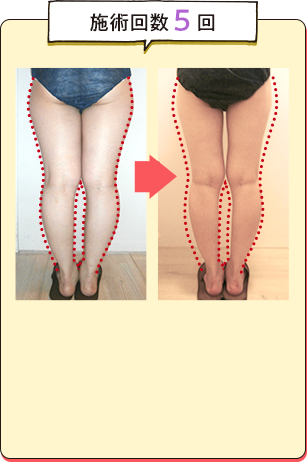 施術回数5回