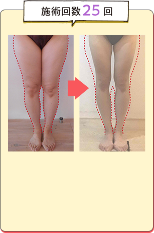 施術回数25回